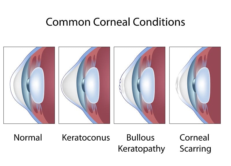 Orthokeratology Lenses 